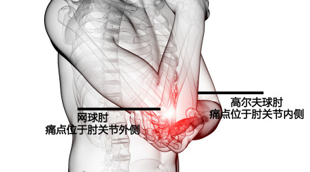 网球肘症状.jpg 网球肘症状.jpg