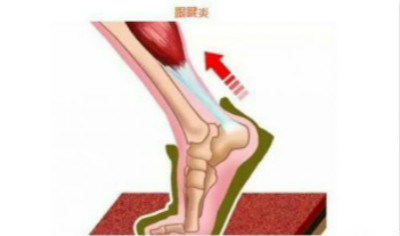 什么是跟腱炎.jpg 什么是跟腱炎.jpg