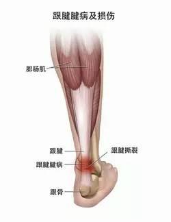 跟腱危害.jpeg 跟腱危害.jpeg