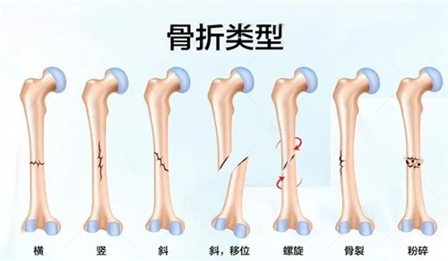济南中德骨科骨折.jpg 济南中德骨科骨折.jpg